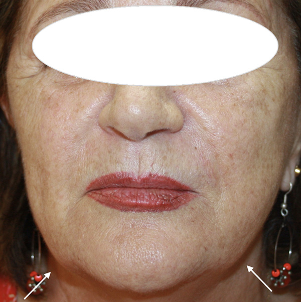 Apr&egrave;s traitement de l'ovale du visage par HIFU, 6 mois