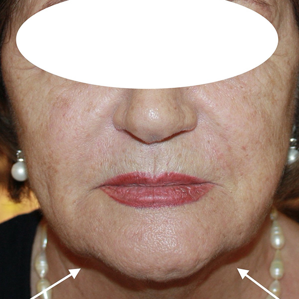Avant traitement de l'ovale du visage par HIFU