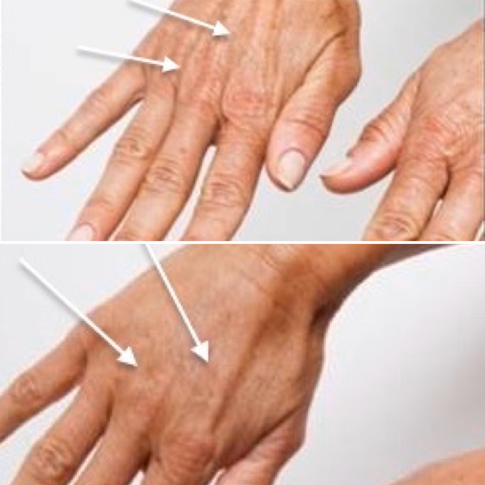 traitement-mauins-injections-acide-hyaluronique-dr-enjelvin-aix-en-provence