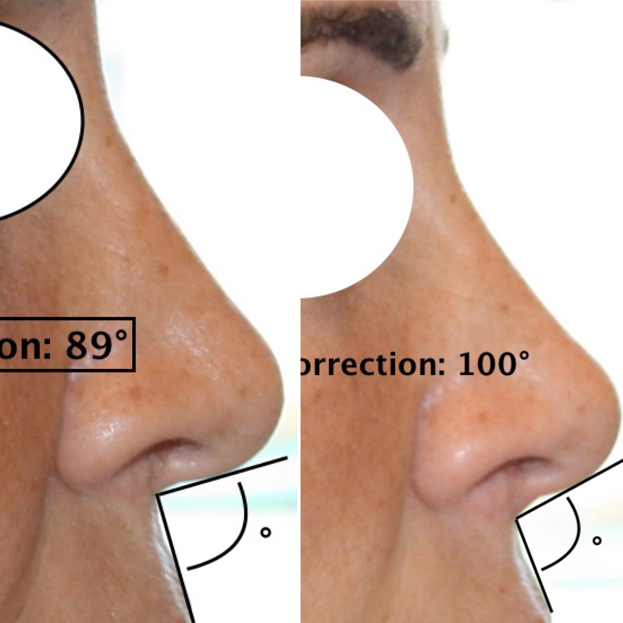 rhinoplastie medicale acide hyaluronique