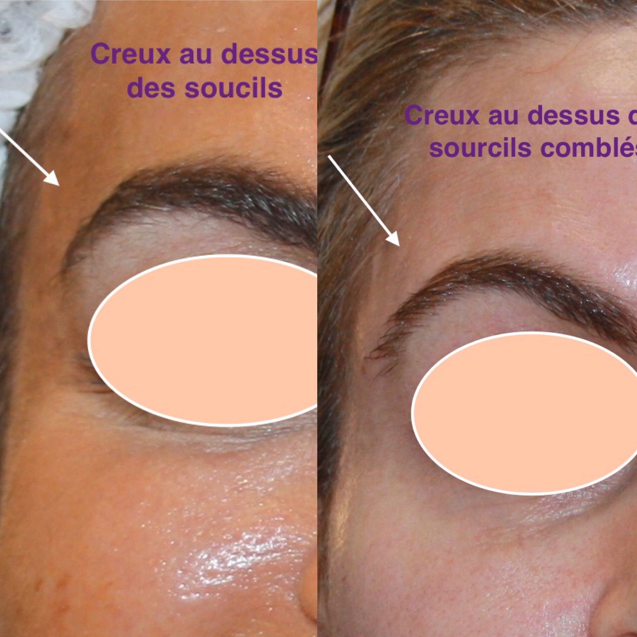 injection botox front resultat